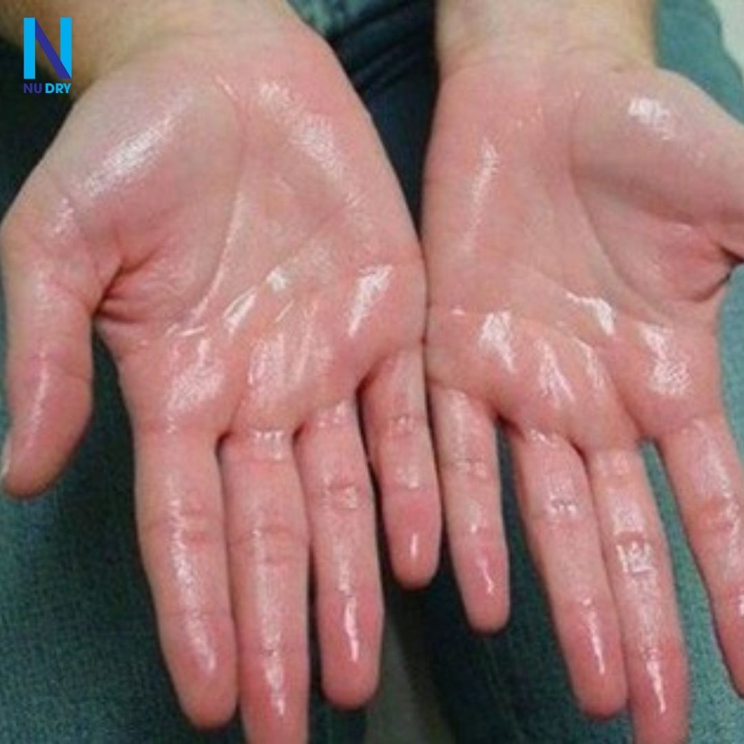Tại Sao Bạn Nên Sử Dụng Túi Hút Mồ Hôi Tay?